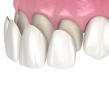 Faccette dentali
