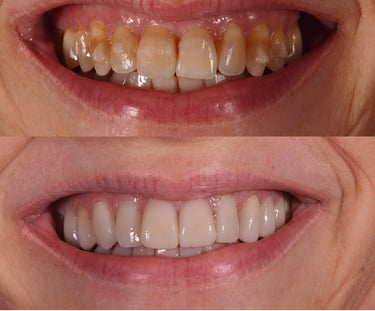 Before and after dental restoration showing yellow stained teeth compared to white porcelain veneers.