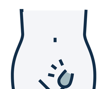 Hérnias inguinal, umbilica, incisional