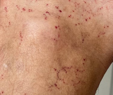 little hematomas on the foot