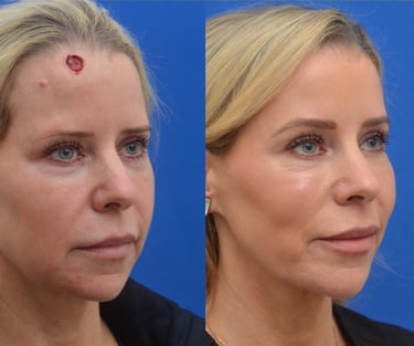 Before and after photos showing Mohs surgery results for skin cancer removal on the forehead