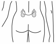 Diagram of Painmaster patches on lower back.