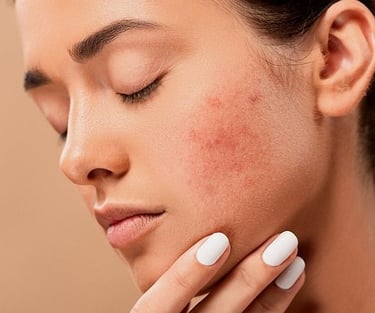 what is acne ?