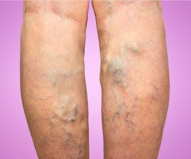 varicose veins treatment.