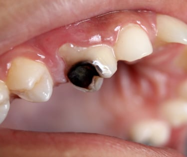 a image showing upper right premolar teeth severly decayed