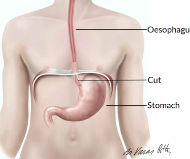 achalasia mutet