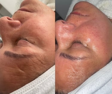 Microdermabrasion