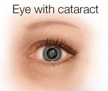 Image of human eye with cloudy cataract in lens.