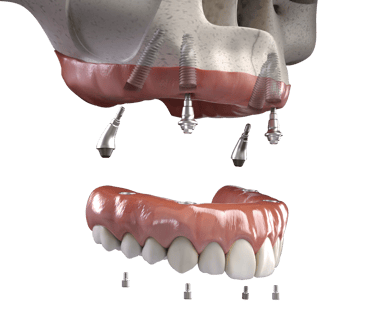 a dental implanting model of a teeth