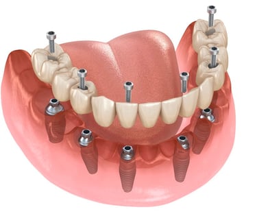 All on six dental implants