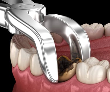 Layanan Ekstraksi Gigi Terpercaya di Klinik Gigi Malang - Sidharta Dental Studio