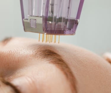 closeup of microneedling treatment on persons eyebrow area