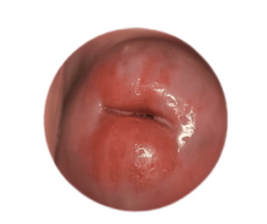 фото Ерозія шийки матки (цервікальна ерозія) на матці