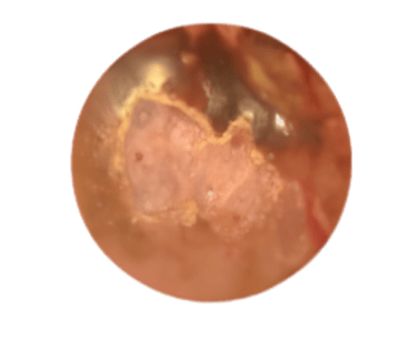 фото Мілія на матці