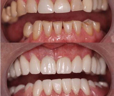 Full Mouth Rehabilitation