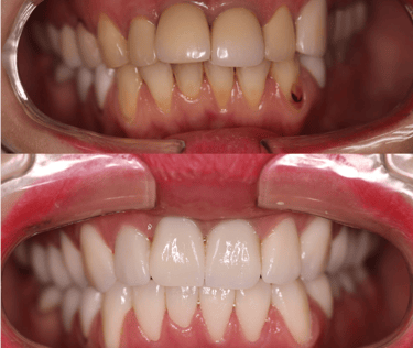 front view of before and after full zirconium crowns