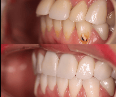 front view of before and after full zirconium crowns