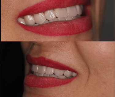side view of before and after full zirconium crowns