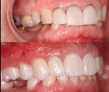 Full Mouth Rehabilitation