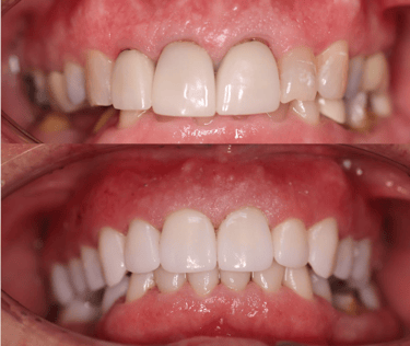 Full Mouth Rehabilitation