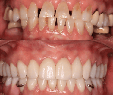 Full Mouth Rehabilitation