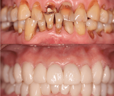 Full Mouth Rehabilitation