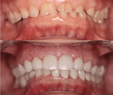 Full Smile Makeover before and after