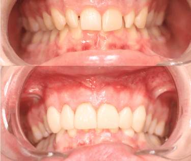 Full Mouth Rehabilitation