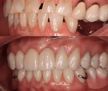Full Mouth Rehabilitation