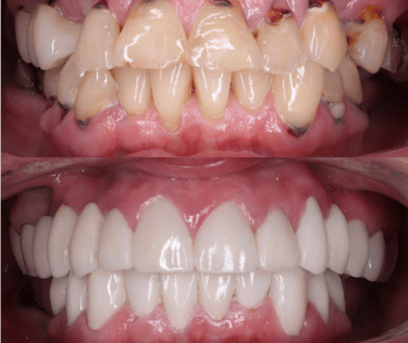 Full Mouth Rehabilitation