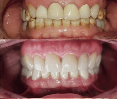 Full Mouth Rehabilitation