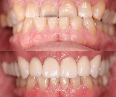 Upper zirconium Crowns