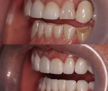 Side view of a before and after full zirconium crowns
