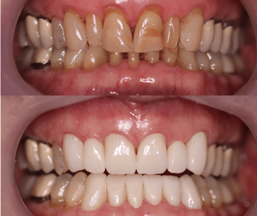 Before and after 12 zirconium crowns