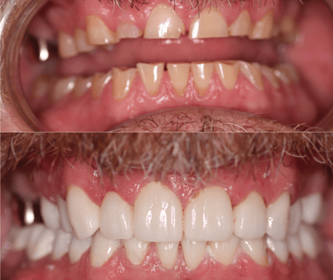 Before and after full mouth rehabilitation 