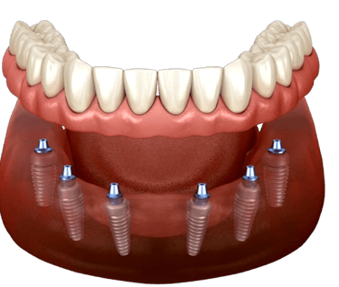 Dentista a Tirana Impianti Dentali Allon4