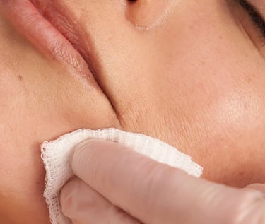 Chemical Peel Stafford