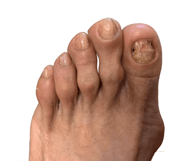 Onicomicosis-hongos-uñas