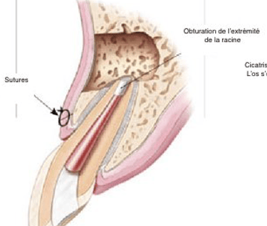 Chirurgie endodontique