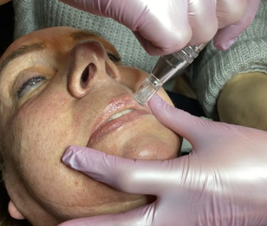 microneedling is de beste anti-age gezichtsbehandeling