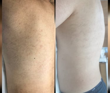 before and after one session laser
