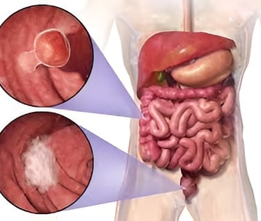 Imagen de Cáncer de Colon utilizado en la pagina web de la Dra. Arlenis Guzmán
