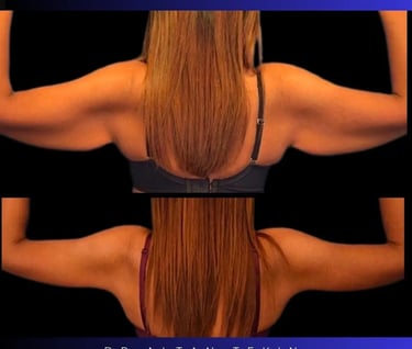 arm lift before after photos in Antalya, Turkey