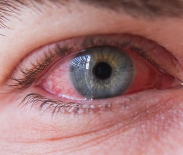 Relief for inflamed red eye
