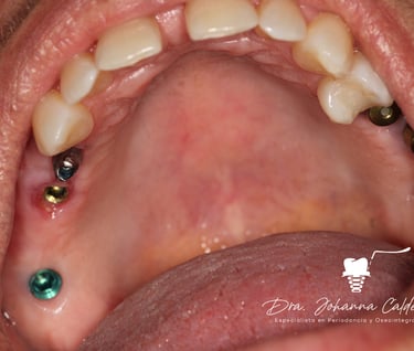 dental implants columbia