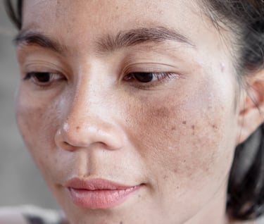 Mélasma du visage, masque de grossesse, personne asiatique avec mélasma