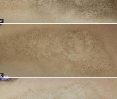 scar before after microneedling