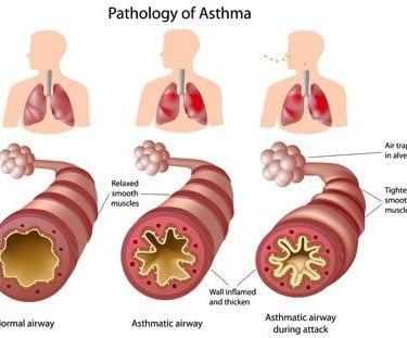 pathology of asthma