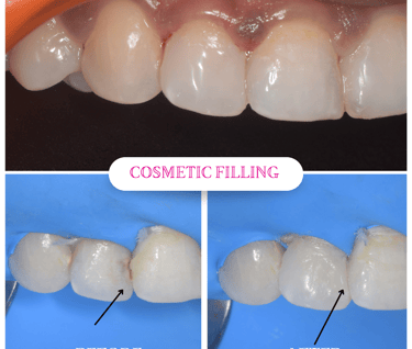 Front tooth cavity treated with Tooth coloured filling done by best cosmetic dentist in Malad Mumbai