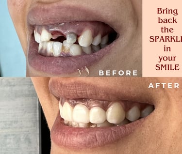 replacing missing teeth with ceramic bridge in malad mumbai